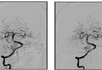 Poszerzyli tętnicę w mózgu. Pierwszy taki zabieg w Bizielu